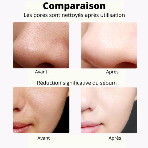 Acide Niacinamide + Sérum Vitamine C = 1 Extracteur de points noirs offert